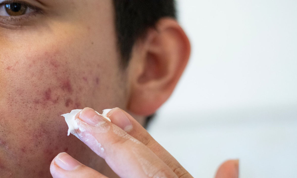 Is tallow actually good for acne-prone skin?